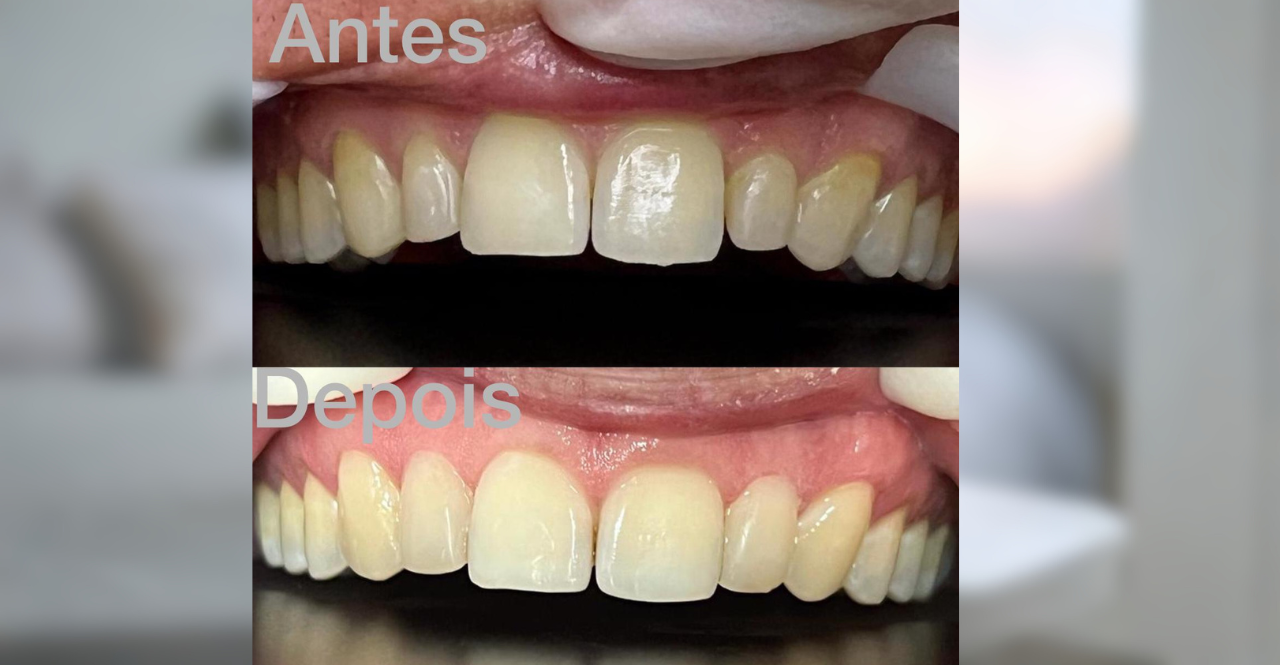 Facetas em Resina em Campo Grande MS