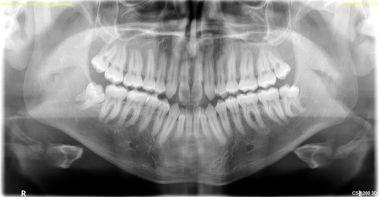 Extração do Siso em Campo Grande MS
